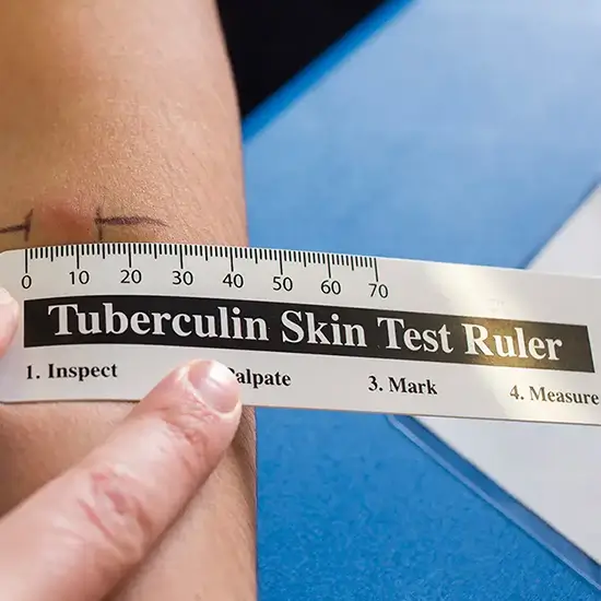 tb (tuberculosis) final diagnosis test